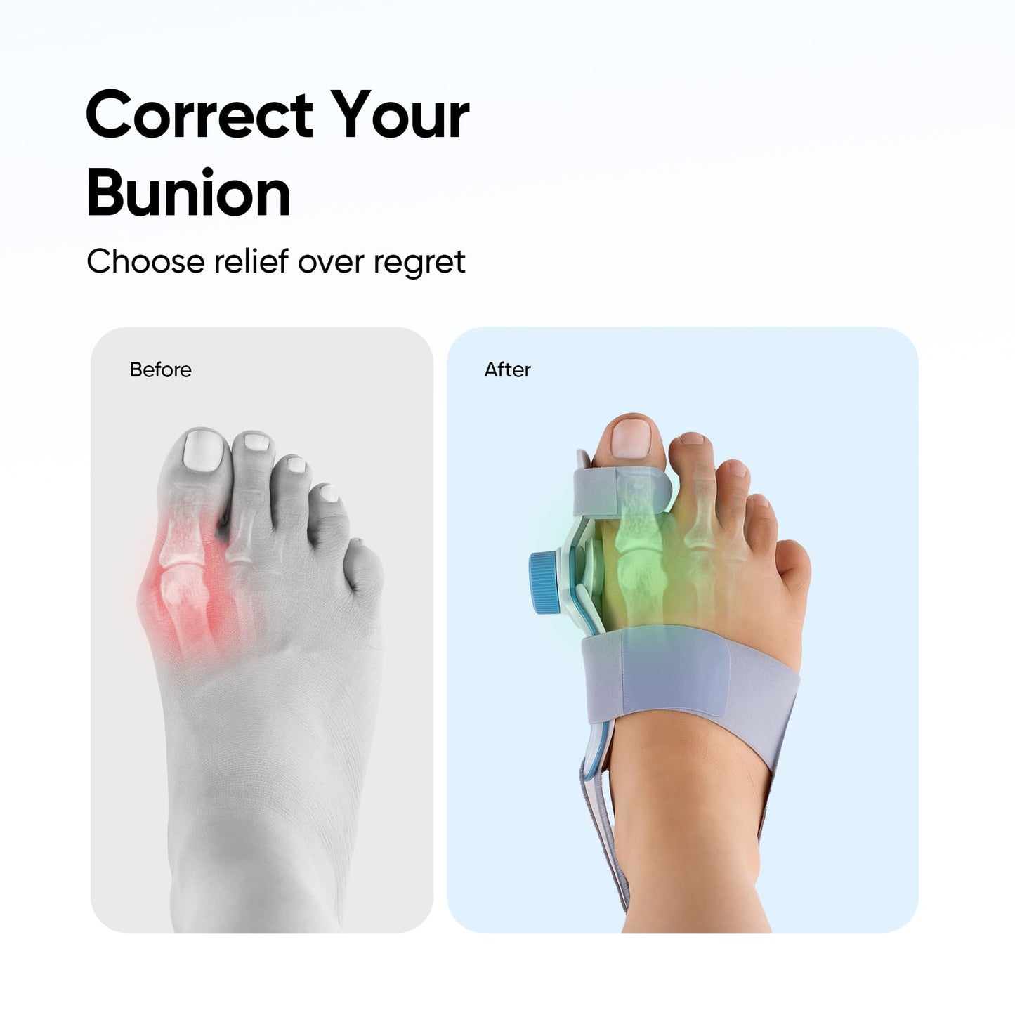 Frido Orthotics Bunion Corrector